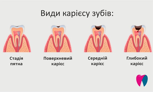 Види карієсу зубів